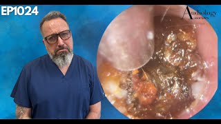 Irritated Ear Canal Wax Removal  EP1024 [upl. by Vano133]