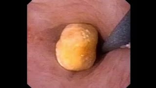 Endoscopia do Ureter  Ureterolitotripsia a Laser [upl. by Leverett]