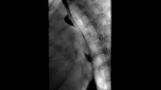 Esophagram Traction Diverticulum [upl. by Yoral]