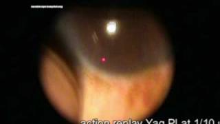 laser iridotomy for angle closure glaucoma [upl. by Annas]