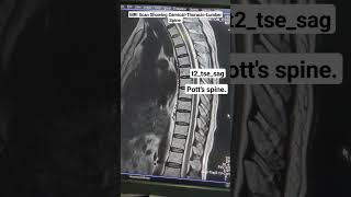 MRI Scan Showing Potts CervicalThoracicLumber Spine t2tsesag Sequence Planning for beginners [upl. by Armington45]