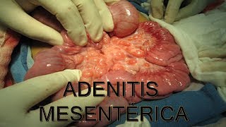 ADENITIS MESENTERICA  MEDICINA HUMANA  MediCiencia [upl. by Cherian487]