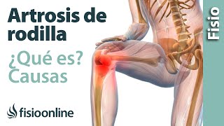 Artrosis o desgaste de rodilla  Qué es causas síntomas y tratamiento [upl. by Bagger19]