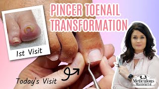 Pincer Ingrown Toenail Transformation How to Pedicure [upl. by Edithe998]