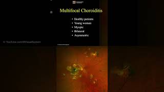 Multifocal Choroiditis ophthalmology optometry [upl. by Aspia]