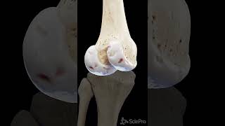 This is how Knee Arthrosis looks like anatomy meded 3danimation [upl. by Yerd523]