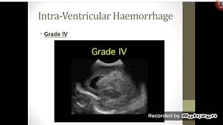 Neonatal Cranial Ultrasound Part 2 [upl. by Meesaw868]