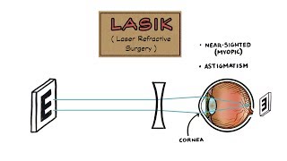 Laser Eye Surgery Procedure Video [upl. by Noelopan]