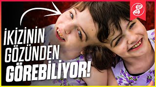 Yapışık İkizler Birbirlerinin Düşüncelerini Okuyabilir mi [upl. by Naitsabas]