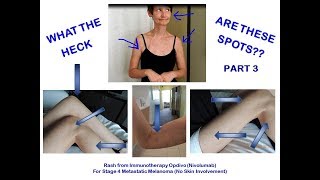 WHAT ARE THESE SPOTS  IMMUNOTHERAPY NIVOLUMAB RASH PART 3 [upl. by Monk431]