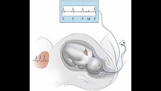 finalyearprojects 2021  Smart Cardiotocography Fetal Monitoring System based on Phonocardiogram [upl. by Noemi]