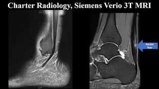 Highgrade Partial Achilles Tendon Tear [upl. by Jock]