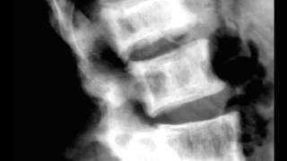 Pagets Disease of the Lumbar Spine on X ray [upl. by Ielirol]