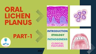 Oral Lichen Planus Part 1  Etiology Lichen Planus  Pathogenesis of Lichen Planus  Wickham Striae [upl. by Yebot246]