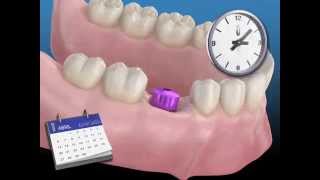 Todo sobre los implantes dentales [upl. by Eniala884]