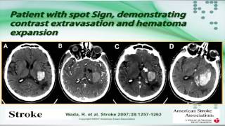 Intracerebral Hemorrhage by Sebastian Koch MD [upl. by Ploch16]