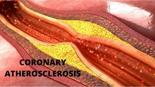 Coronary Atherosclerosis The major cause of heart disease [upl. by Nisse]