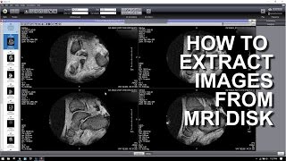 HOW TO EXTRACT IMAGES FROM A MRI DICOM DISK [upl. by Nwahsirhc230]