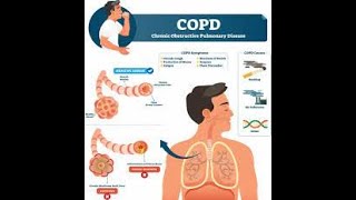 🔴 2 COPD amp Medications DrHazem Sayed [upl. by Ylesara]