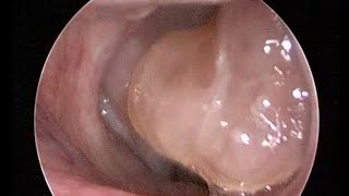 Nose Endoscopy  Chronic Rhinosinusitis with polyposis [upl. by Naired905]