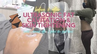 Ultrasonic Fat Cavitation amp Laser Lipo Before and After Review What I Learned After 5 Sessions [upl. by Tammi175]