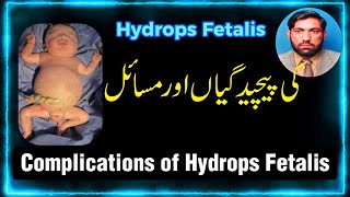 Complications of Hydrops Fetalis کی پیچید گیاں اور نقصانات Hydrops Fetalis [upl. by Kcirddet]