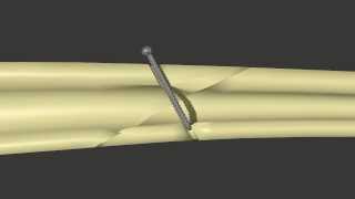 Fracture Fixation Lag Screw [upl. by Renaud]