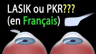 LASIK ou PKR Comparaison des procédures animation [upl. by Hegarty769]