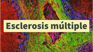 Esclerosis múltiple diagnóstico síntomas tratamiento y pronóstico pérdida de mielina [upl. by Lerraj]