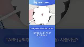 부산백병원 수술 불가능한 간암에 ‘방사선 색전술’로 치료길 연다 [upl. by Flint]