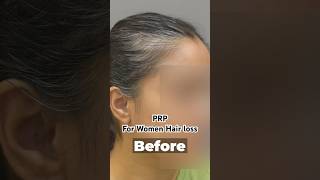 Female PRP Results  Treatment For Women Hair Loss Before amp After [upl. by Orr]