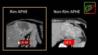 5 LIRADS Malignant lesions that are not definitely HCC LRM  Part 1 By Dr Kathryn Fowler [upl. by Meekah]