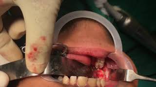 Mandibular dentigerous cyst enucleation video at Richardsons Craniofacial Hospital [upl. by Anilos]