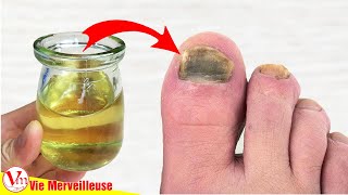 Comment Enlever Les Mycoses Des Ongles Des Pieds Rapidement Et Naturellement  Remèdes Maison [upl. by Atsahs]