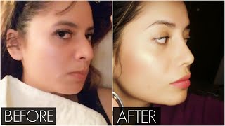 My Rhinoplasty Experience in Canada VLOG  Surgery to One Month Post Op  Nose Job Before and After [upl. by Frentz]