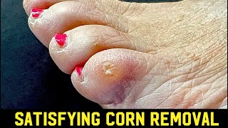 SATISFYING DEEP CORN REMOVAL  FEELING STRESSED SIT BACK amp ENJOY [upl. by Medrek484]