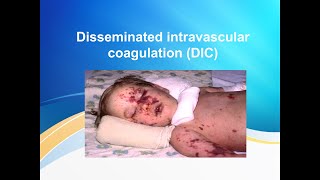 Disseminated intravascular coagulation DIC [upl. by Lalla]