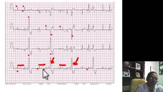 INTERPRETACION EKG EXTRASISTOLES VENTRICULARES [upl. by Reivilo114]