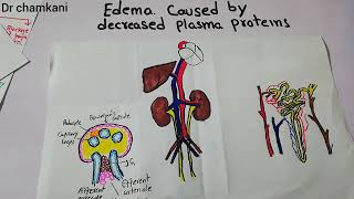 Renal physiology 27  Causes of edema caused by decreased plasma proteins DrChamkani [upl. by Cuttler519]