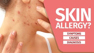 What is Skin Allergy Symptoms Causes Diagnosis and Triggers [upl. by Munster107]