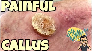 SATISFYING CALLUS REMOVAL FROM FEET [upl. by Aleacin]