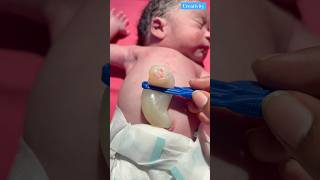 How Big Umbilical Cordmedical newbornbaby viralvideo [upl. by Hilde]