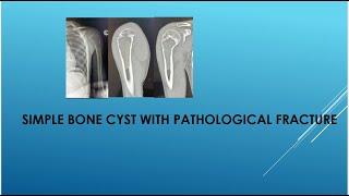 Simple bone cyst with pathological bone fracture [upl. by Eenhat]