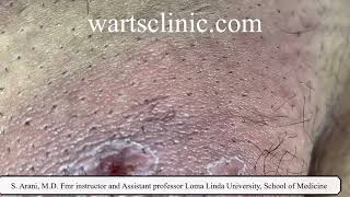 Molluscum self treatment causing deep skin infection and abscess [upl. by Athal668]