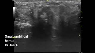 Small umbilical hernia through defect in abdominal wall at umbilicus ultrasound video [upl. by Ayamahs]