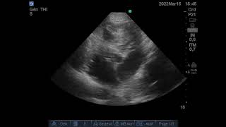 CardioMyopathie Hypertrophique CMH Échographie Dilatation Cavitaire droite [upl. by Ajna]