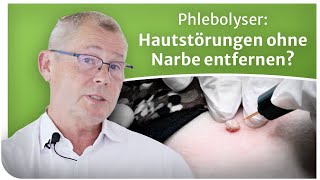 Phlebolyse Hautstörungen ohne Narbe und Betäubung entfernen Interview mit Andreas Oehme [upl. by Arutak]