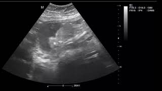 CASE 552 3D 4D ultrasound fetal achondroplasia [upl. by Sale178]