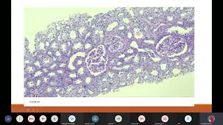 Rapidly Progressive Glomerulonephritis RPGN [upl. by Ireva663]