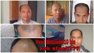 Update 10 bulan Minoxidil Untuk Rambut Botak [upl. by Enaoj]